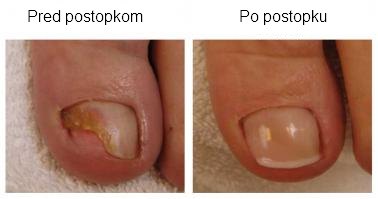 Nohtna protetika Nohtna protetika